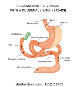 Biliopancreatic Diversion With A Duodenal Siwtch (BPD-DS)