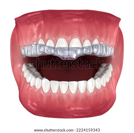 Bite Splint - bite correction. Medically accurate dental 3D illustration