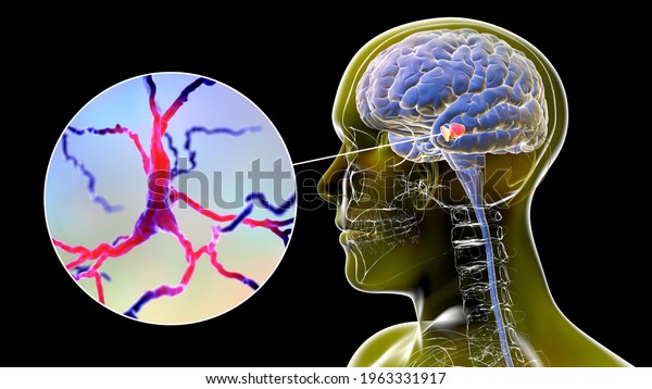 Black substance of the midbrain and its\
dopaminergic neurons, 3D illustration. Black substance regulates\
movement and reward, its degeneration is a key step in development\
of Parkinson\'s\
disease