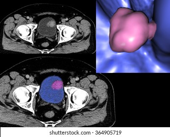 Bladder Cancer, CT