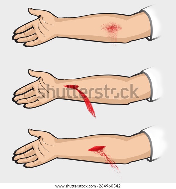 Bleeding Types Bleeding Classification Classification Bleeding Stock ...