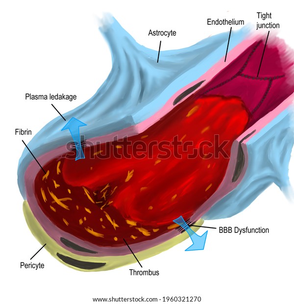 Blood Brain Barrier Leakage Inschemic Stroke Stock Illustration ...