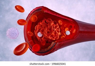 Blood cells clot in the human body blood vessels. Artery, vein blockage with coagulated cells, deep vein thrombosis health risk. Thrombus, embolus, embolism, blood flow 3d medical science illustration