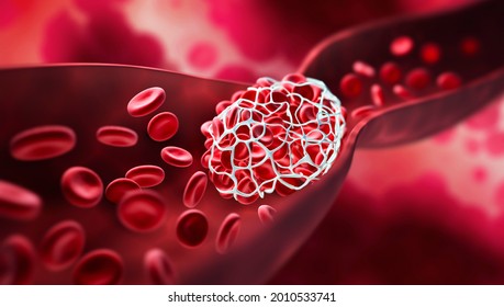 Blood Clot Blocking A Blood Vessel - 3D Illustration