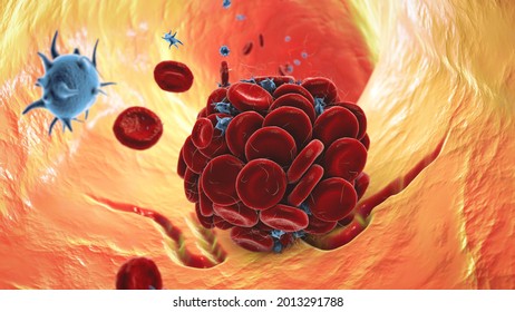 Blood Clot In Damaged Blood Vessel Made Of Red Blood Cells, Platelets And Fibrin Protein Strands. Thrombus, 3D Illustration