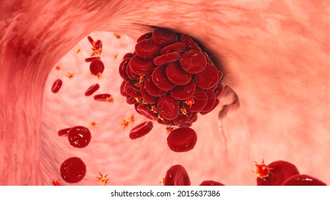 Blood clot in damaged blood vessel made of red blood cells, platelets and fibrin protein strands. Thrombus, 3D illustration