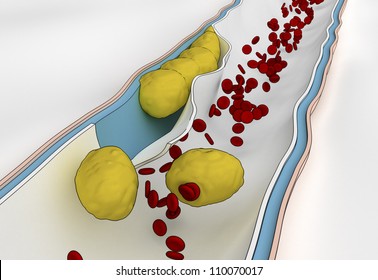 Blood Clot Formation Around Plaque