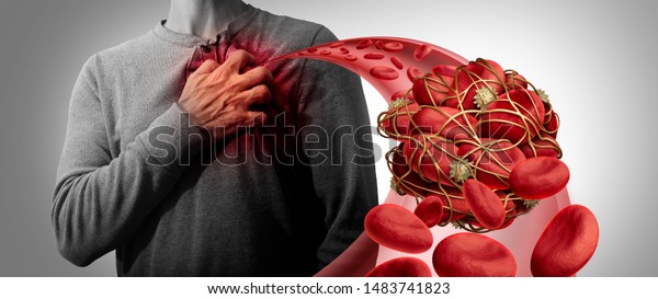 Blood clot health risk or thrombosis medical\
illustration symbol as a group of human blood cells clumped\
together as a blockage in an artery leading to the heart with 3D\
illustration\
elements.