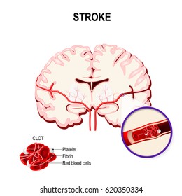 Blood Clot In The Human Brain. Ischemic Stroke In The Cerebral Artery And Thrombus.