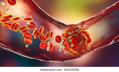 Blood Clot Made Of Red Blood Cells, Platelets And Fibrin Protein Strands. Thrombus, 3D Illustration