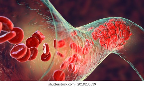 Blood Clot Made Of Red Blood Cells, Platelets And Fibrin Protein Strands. Thrombus, 3D Illustration