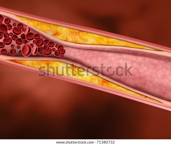 Blood Clot Plaque Artery Restricting Blood Stock Illustration 71380732