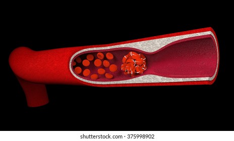 A Blood Clot, Blood Clot, Blood Poisoning Or Cancer, On A White Background.