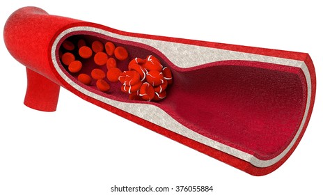 A Blood Clot, Blood Clot, Blood Poisoning Or Cancer, On A White Background.