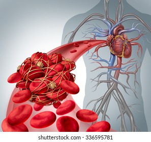 Blood Clot Risk And Thrombosis Medical Illustration As A Group Of Human Blood Cells Clumped Together By Sticky Platelets And Fibrin Creating A Blockage In An Artery Or Vein Leading To The Heart.