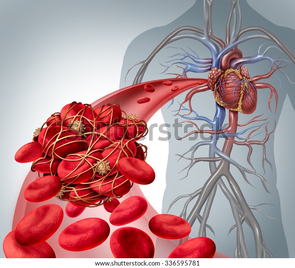 Blood clot risk and thrombosis medical\
illustration as a group of human blood cells clumped together by\
sticky platelets and fibrin creating a blockage in an artery or\
vein leading to the\
heart.