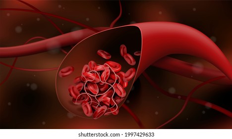 The Blood Clot Stops The Flow Of Red Blood Cells. 3d Vector Illustration