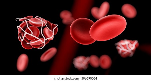 Blood Clot And Thrombosis Medical 3d Illustration Concept.