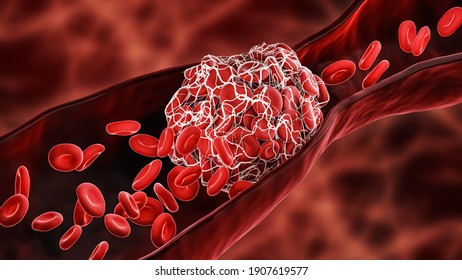 Blood Clot or thrombus blocking the red blood cells stream within an artery or a vein 3D rendering illustration. Thrombosis, cardiovascular system, medicine, health, anatomy, pathology concepts.