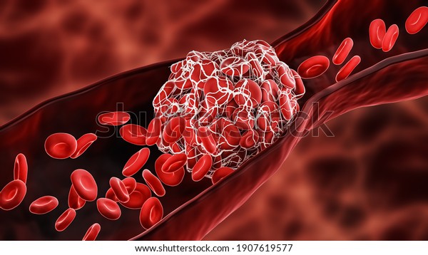 Blood Clot or thrombus blocking the red blood\
cells stream within an artery or a vein 3D rendering illustration.\
Thrombosis, cardiovascular system, medicine, health, anatomy,\
pathology\
concepts.