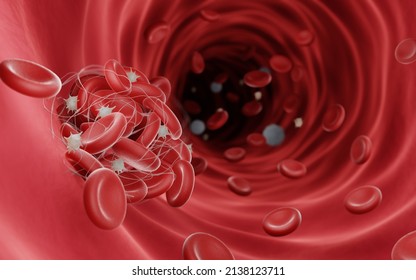 Blood clots (fibrin clots) are usually formed to stop the bleeding during injury, Blood clots can be dangerouse when they obstruct blood flow and cause thrombosis, 3d illustration