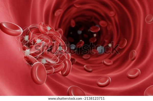 Blood clots (fibrin\
clots) are usually formed to stop the bleeding during injury, Blood\
clots can be dangerouse when they obstruct blood flow and cause\
thrombosis, 3d\
illustration