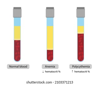 Blood Inside A Test Tube With Differentes Concentrations Of Hematrocrit. Normal, Anemia And Polycythemia.