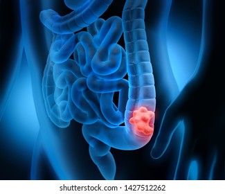 Body with intestinal polyp - 3D illustration