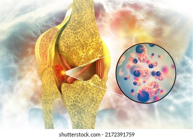 Bone Cancer, Knee Joint, Giant Cell Tumor Of Bone, Osteosarcoma, 3d Illustration