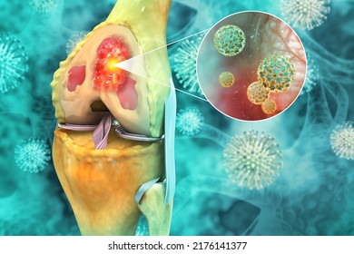 Bone Cancer, Knee Joint, Giant Cell Tumor Of Bone, Osteosarcoma, 3d Illustration