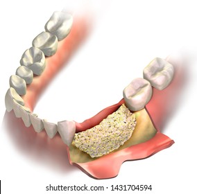 Bone Graft On Loss Bone In Lower Jaw Before Close It With Gums. Vertical Bone Regeneration. 3D Illustration.