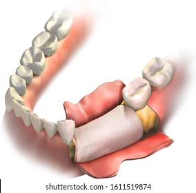 Bone Graft Placement On Missing Teeth 21, 20, 19 And Bone Lossed, Closing By Dental Membrane. 3D Illustration. Regenerative Collagen Dental Membrane Closed On Bone Graft Before Gum Closing.