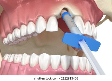 Bone Grafting Augmentation, Socket Preservation, Tooth Implantation. Medically Accurate 3D Illustration.