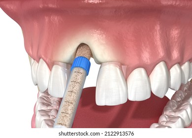 Bone Grafting Augmentation, Socket Preservation, Tooth Implantation. Medically Accurate 3D Illustration.