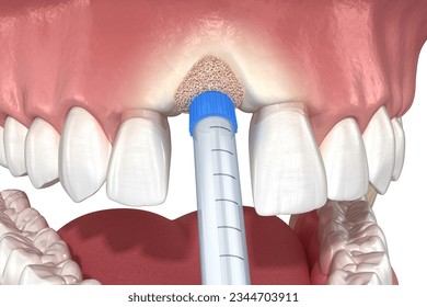 Bone grafting augmentation, socket preservation, tooth implantation. Medically accurate 3D illustration.