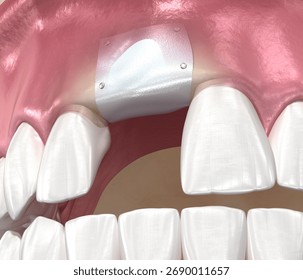 Bone grafting augmentation, socket preservation, tooth implantation. Medically accurate 3D illustration.