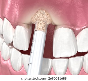 Bone grafting augmentation, socket preservation, tooth implantation. Medically accurate 3D illustration.