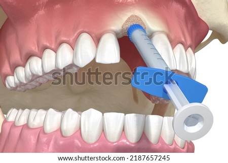 Bone grafting augmentation, socket preservation, tooth implantation. Medically accurate 3D illustration.