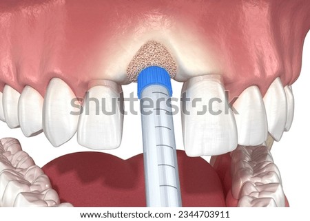 Bone grafting augmentation, socket preservation, tooth implantation. Medically accurate 3D illustration.