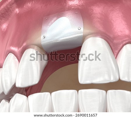 Bone grafting augmentation, socket preservation, tooth implantation. Medically accurate 3D illustration.