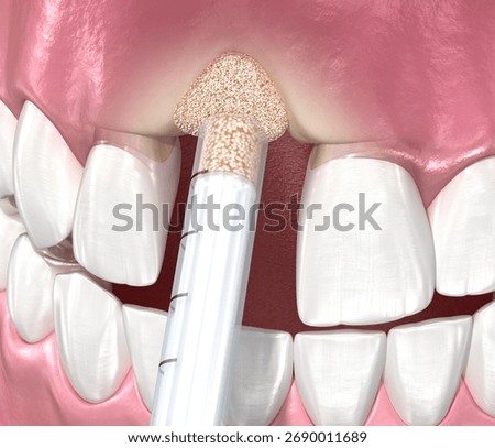 Bone grafting augmentation, socket preservation, tooth implantation. Medically accurate 3D illustration.