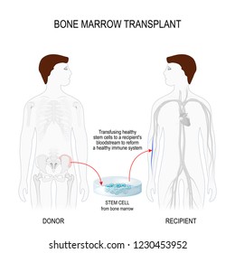 Bone Marrow Transplant.  Men Silhouettes (recipient And Donor) With Highlighted Of The Skeleton And Blood Vessel. Transfusing Healthy Stem Cells From Donor To A Recipient's Blood Stream 