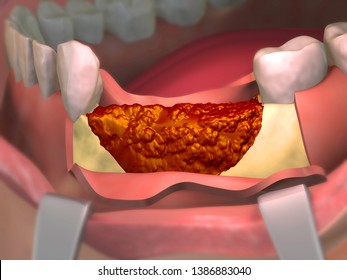 Bone Regeneration After Tooth Removal Using Bone Graft. 3D Illustration.