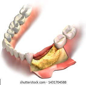 Bone Regeneration Using Bone Graft. Transparent Graft On His Place Of Missing Teeth On Lower Jaw. 3D Illustration.