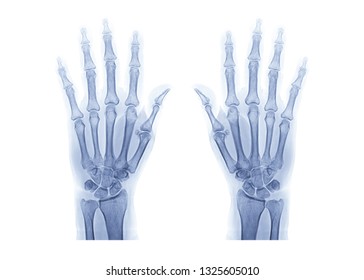  both hand AP view isolated on white background . x-ray image of hand. - Shutterstock ID 1325605010