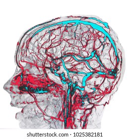 Brain Arteries And Veins, MR Angiography Image, In Blue And Red