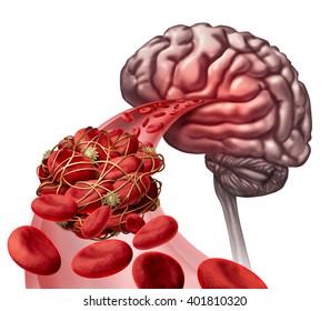 Brain Blood Clot Medical Concept As 3D Illustration Blood Cells Blocked By An Artery Blockage Thrombus Causing A Blockage Of Blood Flow To The Neurology Anatomy.