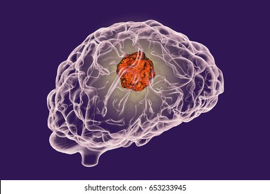 Brain cancer, 3D illustration showing presence of tumor inside brain