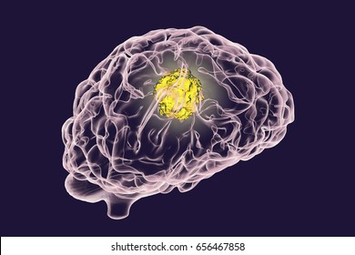 Brain Cancer, 3D Illustration Showing Presence Of Tumor Inside Brain