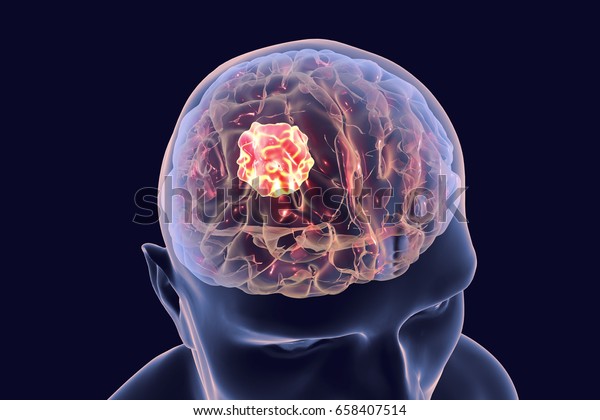 Brain cancer, 3D illustration showing presence of\
tumor inside brain